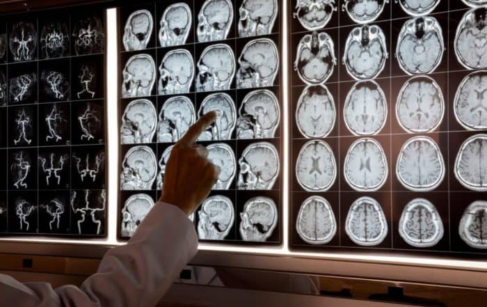 Doctor analyzing brain scans on a monitor